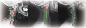 Fisioterapia Toledo radiografía columna vertebral